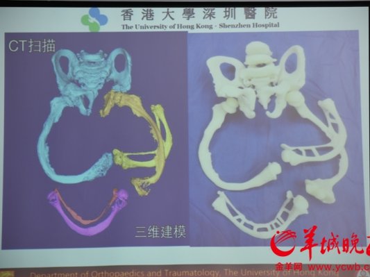 3D打印帮助6岁“玻璃骨”男孩重新站立