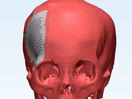 重庆完成罕见颅面部畸形3D打印假体置换手术