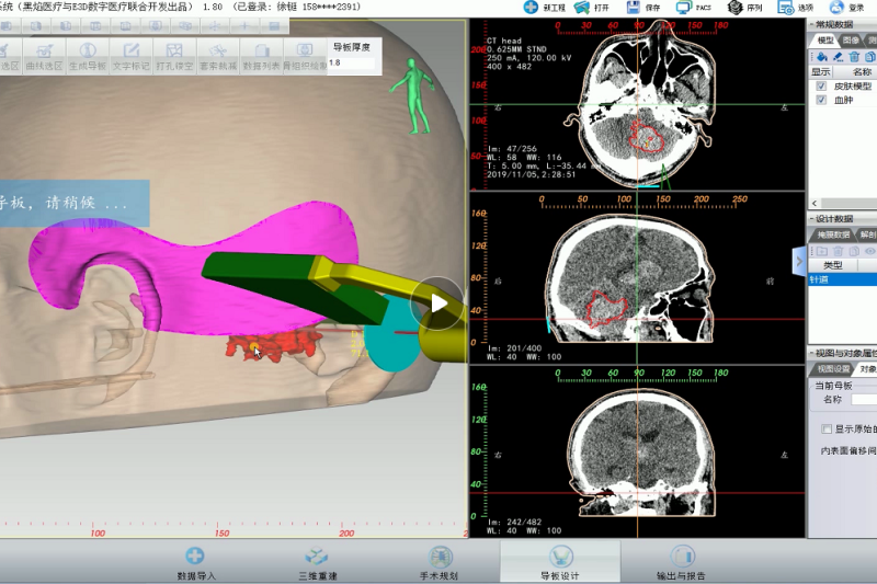 即时3D打印导板辅助脑出血微创手术 黑焰医疗与徐永革团队助力基层医院 --精致的脑出血微创手术 基层医院也能做到